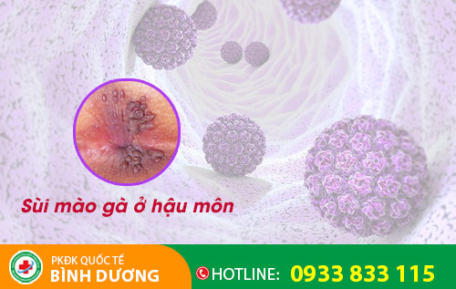 Sùi mào gà ở hậu môn