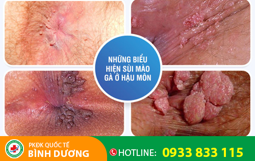 Sùi mào gà ở hậu môn