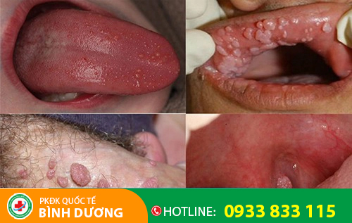 Ảnh sùi mào gà ở họng
