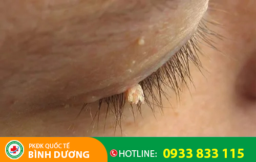 Hình ảnh sùi mào gà ở mắt
