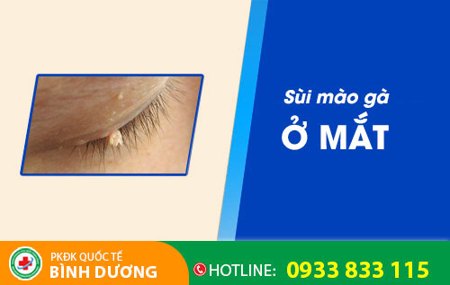 Sùi mào gà ở mắt