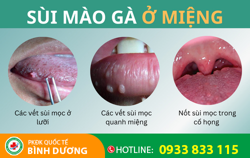 Hình ảnh sùi mào gà ở miệng