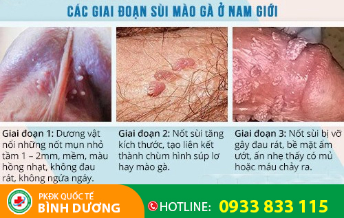 Sùi mào gà dương vật