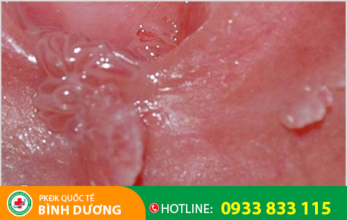 Hình ảnh sùi mào gà ở nữ giai đoạn đầu