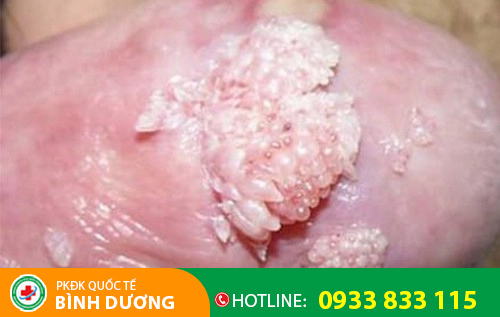 Hình ảnh sùi mào gà ở rãnh quy đầu