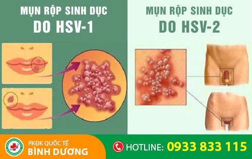 Mụn rộp sinh dục lây nhiễm chủ yếu qua đường quan hệ tình dục không an toàn