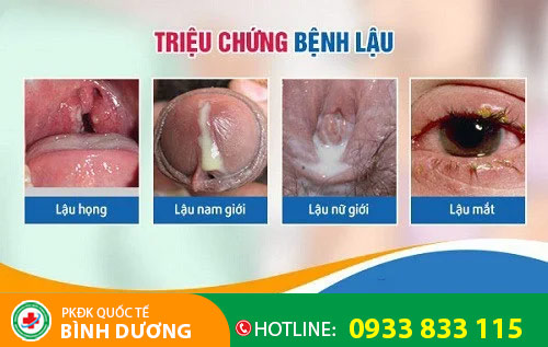 Triệu chứng bệnh lậu mãn tính
